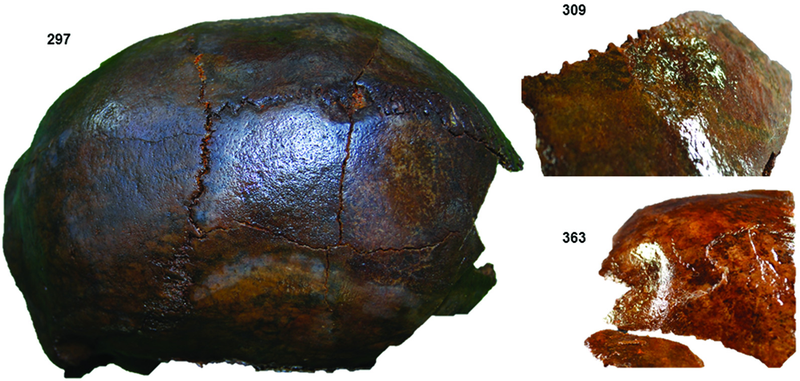 Examples of blunt force trauma from analyzed individuals. (Image: Sara Gummesson and Fredrik Hallgren)